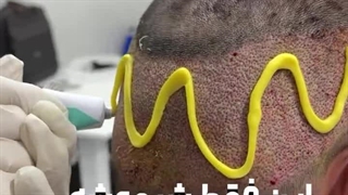 نتیجه کاشت مو در کلینیک آفرینش