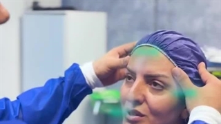 بهترین جراح لیفت ابرو و شقیقه در تهران