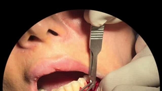 نمونه برداری (بیوپسی) از فک و لثه توسط دندانپزشک متخصص