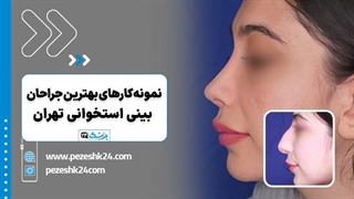بهترین دکتر عمل بینی استخوانی در تهران با پزشک 24