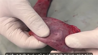 کنترل اشتها از ریشه با حذف فوندوس معده