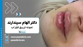 فیلم قبل و بعد تزریق ژل لب دکتر الهام سپندارند در مشهد - پزشک 24