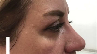 مزونیدلینگ ارکیده ساری