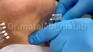 نخ لیفت غبغب | فرم‌ دهی خط فک و جوانسازی بدون جراحی