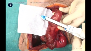 9 Bowel Anastomosis - End to Side Handsewn