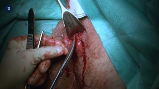 15 Hemorrhoidectomy