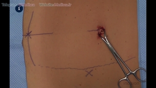 16 Laparoscopic Appendectomy