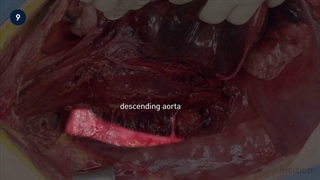 37 Open Esophagectomy
