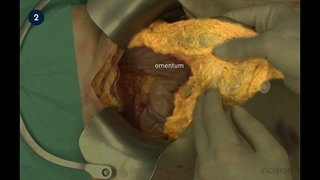 46 Open Partial Gastrectomy - BI Reconstruction