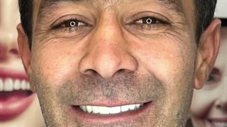 ایمپلنت تمام فک قبل و بعد