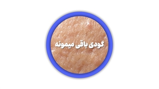 اسکار فرورفته