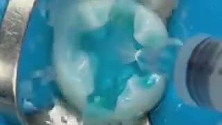 پر کردن دندون