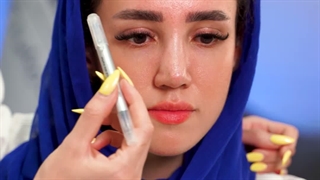 نمونه کار فیلر فول فیس | فرم‌دهی و جوانسازی چهره در کلینیک آرمو