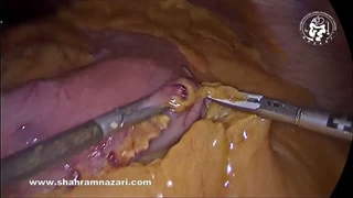 اسلیو گاسترکتومی لاپاراسکوپی همراه با برداشتن کیسه صفرا (کوله‌سیستکتومی)