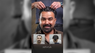 از کم‌پشتی تا تراکم بیشتر؛ نتیجه کاشت مو از نزدیک