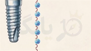 قیمت ایمپلنت سوئیسی در سال ۱۴۰۵ چقدره؟