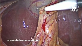 کنجکاوی آناتومیک: وقتی چسبندگی‌ها به کیسه صفرا شکلی غیرمنتظره می‌دهند