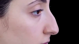 رینوپلاستی درمانی